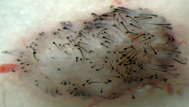 Волосы,выращенные на ноге мыши,после пересадки клеток сосочков дермы,полученных из плюрипотентных стволовых клеток человека